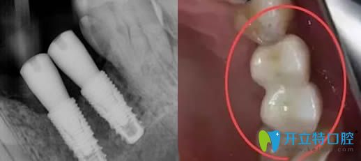 種植體歪了可以做牙冠調(diào)整修復(fù)