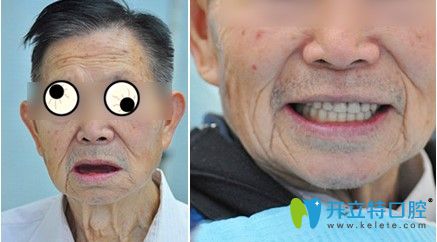 在天津中諾做過立得用全口種植牙對比效果