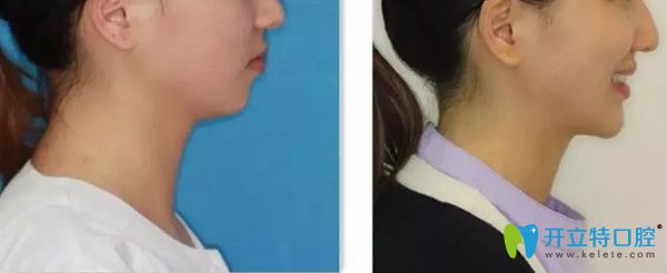 牙齒矯正前后照片