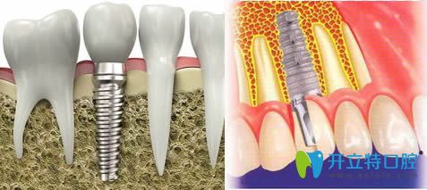好奇!種植體為什么會(huì)種歪呢?種植體歪了可以調(diào)整嗎?