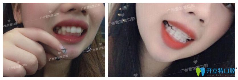 廣州壹加壹齙牙、牙齒擁擠不齊矯正案例效果前后對比照片