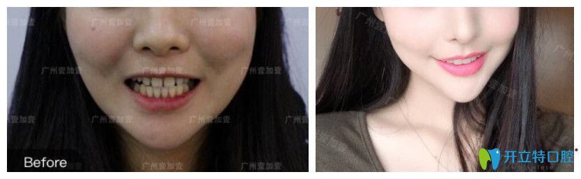 牙縫大采用美加瓷貼面修復(fù)對比圖