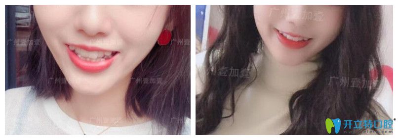 正畸和瓷貼面修復(fù)顧客用案例驗(yàn)證廣州壹加壹口腔怎么樣