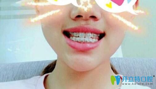 <!--<i data=20240703-sp></i>-->口腔矯正四個月牙齒變化圖 <!--<i data=20240703-sp></i>-->口腔矯正四個月牙齒變化圖