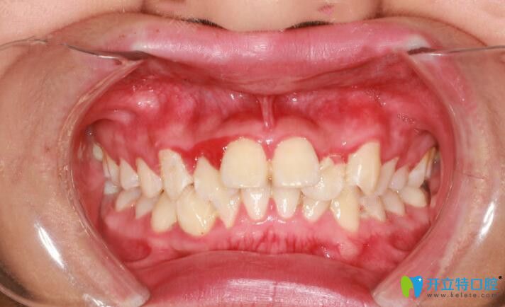 我大兔牙做了金屬托槽矯正，來(lái)分享我4個(gè)月來(lái)牙齒變化圖