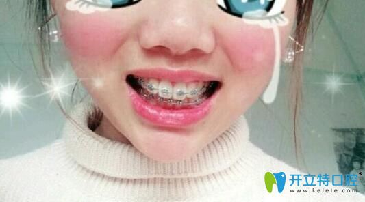 大兔牙牙齒矯正62天 大兔牙牙齒矯正62天