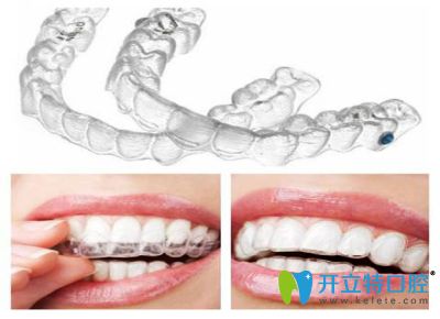 清遠中大口腔醫(yī)院張廣興院長分享隱形牙齒矯正優(yōu)勢