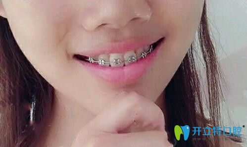 戴金屬牙套100天牙齒變化圖 戴金屬牙套100天牙齒變化圖