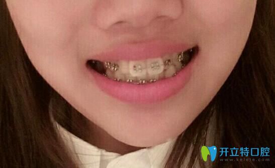 在<!--<i data=20240703-sp></i>-->口腔矯正大兔牙30天 在<!--<i data=20240703-sp></i>-->口腔矯正大兔牙30天