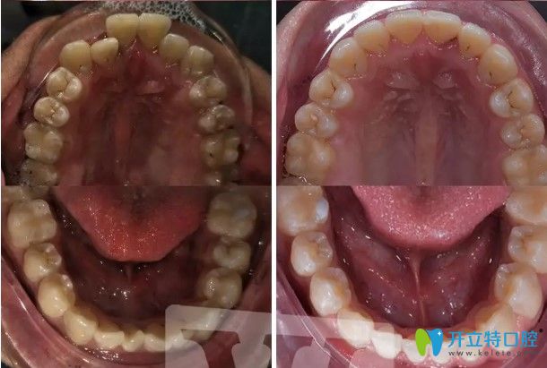佩戴金屬牙套后的牙齒變化圖