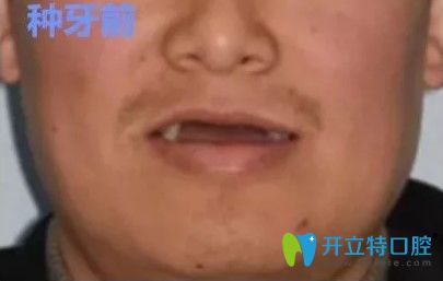 張先生來(lái)韓國(guó)安特麗牙科做種植牙術(shù)前照 張先生來(lái)韓國(guó)安特麗牙科做種植牙術(shù)前照