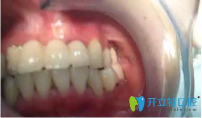 劉女士做完全口種植牙后的效果 劉女士做完全口種植牙后的效果