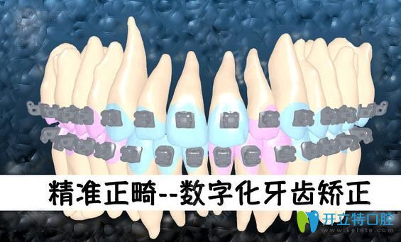 清遠中大口腔阮葦醫(yī)生介紹數字化正畸技術優(yōu)勢