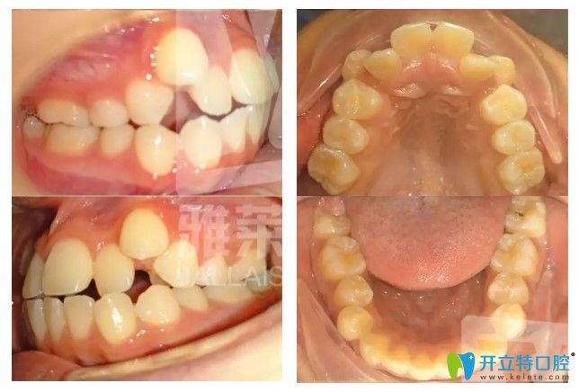 杭州雅萊口腔怎么樣?看做過(guò)隱適美對(duì)刃頜矯正的顧客如何說(shuō)