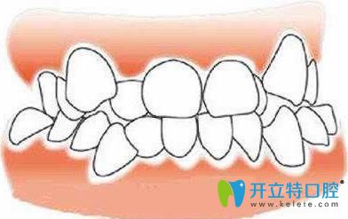 牙齒擁擠在正畸時就需要拔牙矯治