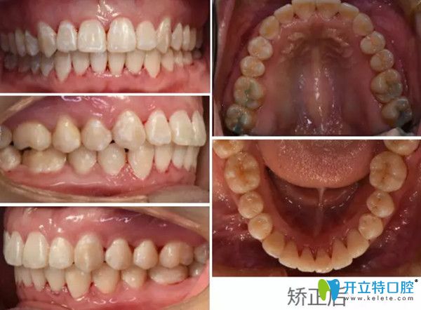 正畸前后對(duì)比圖