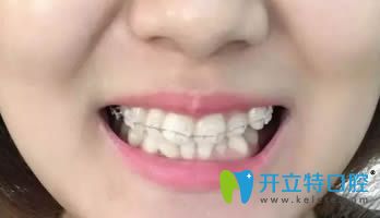 在連江縣明輝口腔做的陶瓷矯正歷經(jīng)18個(gè)月終于要下牙套了！