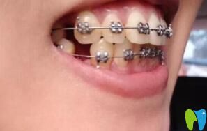 <!--<i data=20240703-sp></i>-->圣貝口腔章依文醫(yī)生給我做牙齒矯正第3個月