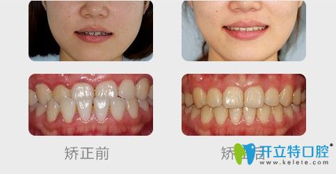 沈陽盛大口腔青少年地包天案例效果