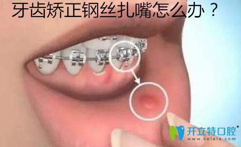 金屬托槽牙齒矯正鋼絲扎嘴磨嘴怎么辦？