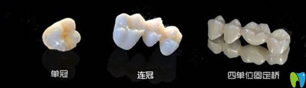當(dāng)牙齒缺損時，選擇單冠好還是連冠好？