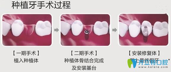 泉州維樂口腔徐震武醫(yī)生介紹種植牙過程