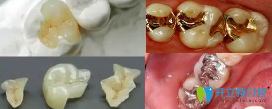 牙齒嵌體修復效果圖