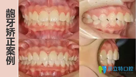 中山美南華口腔牙性+骨性齙牙矯正案例