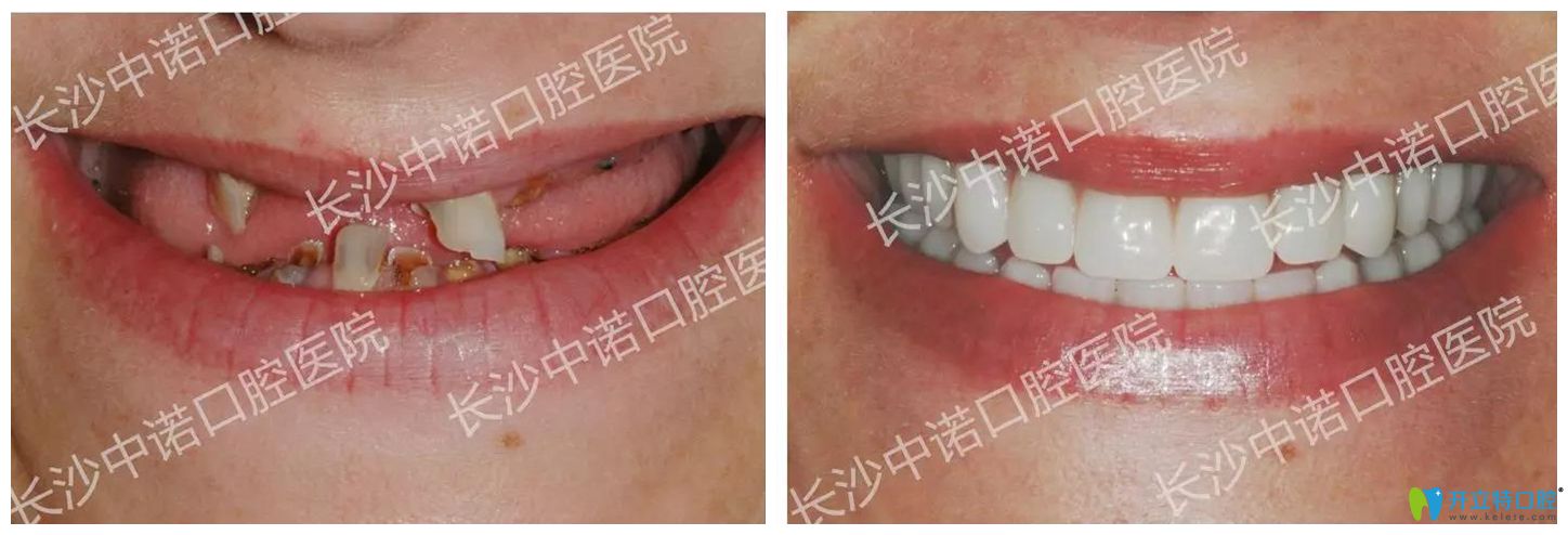長(zhǎng)沙中諾口腔立得用種植牙效果