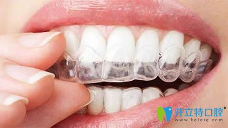 分析:國(guó)產(chǎn)隱形牙套品牌中時(shí)代天使與達(dá)芬奇隱形矯正哪種好?