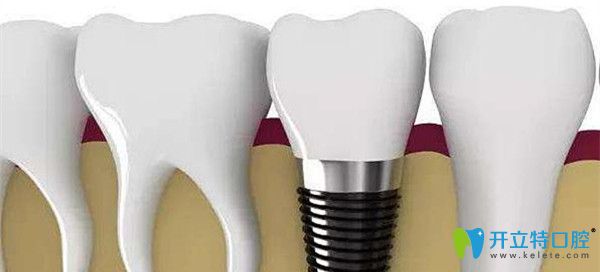 種植牙包含基臺、種植體、牙冠