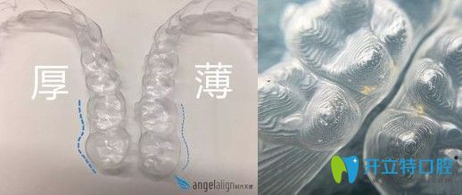 時(shí)代天使隱形牙套細(xì)節(jié)圖