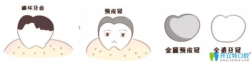 兒童乳牙預(yù)成冠是什么？比樹(shù)脂填充好在哪里？