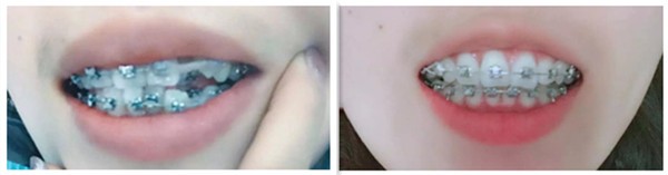 矯正虎牙需要多久？看我在武漢正璞口腔正畸第165天的效果