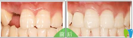 福州維樂口腔諾貝爾種植牙