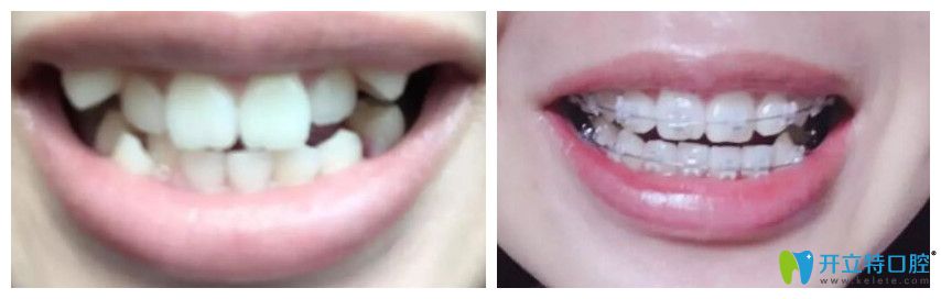 廣州壹加壹口腔靠譜嗎?聽聽牙齒擁擠和虎牙矯正顧客怎么說