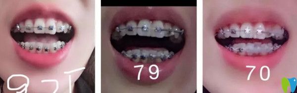 金屬托槽矯正第三個(gè)月記錄照