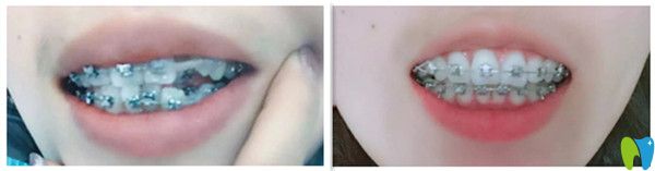 虎牙矯正前后對(duì)比圖