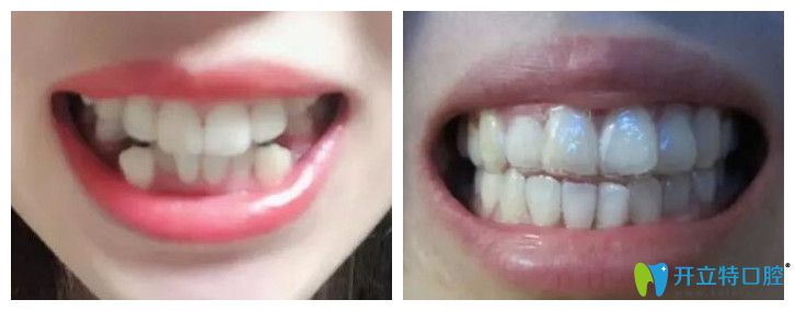 廣州壹加壹口腔牙齒擁擠矯正實(shí)例