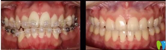 長沙中諾半隱形案例