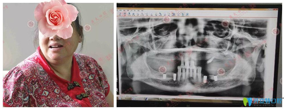 廣州種植牙醫(yī)院哪家好？廣大口腔顧客種植牙真人案例來驗(yàn)證