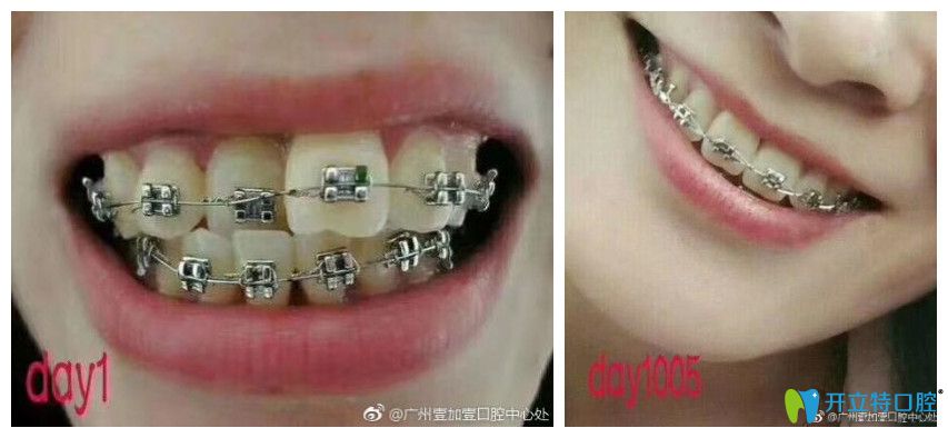 牙齒擁擠不齊，個別反頜小姐姐也來打卡啦