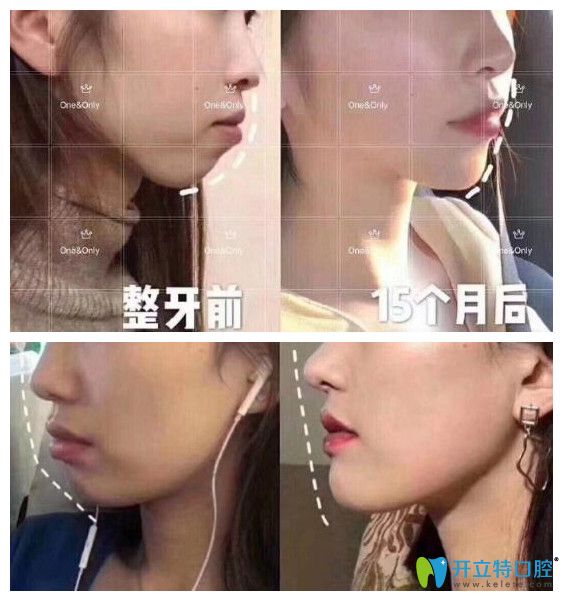 廣州壹加壹矯正牙齒好嗎？小姐姐在壹加正畸打卡記錄公開