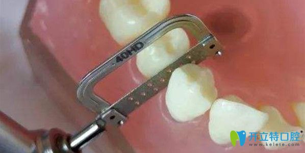 鄰面去釉后悔了，哪些情況可以做鄰面去釉？