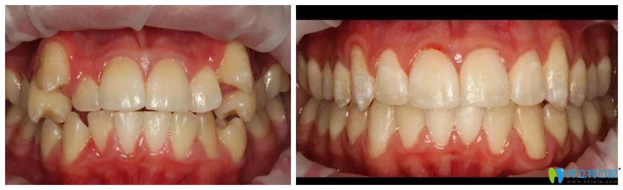 武漢德韓口腔牙齒矯正案例