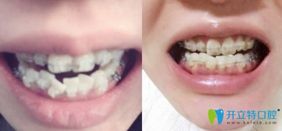 杭州時(shí)光口腔陶瓷牙套矯正1個(gè)月照 杭州時(shí)光口腔陶瓷牙套矯正1個(gè)月照