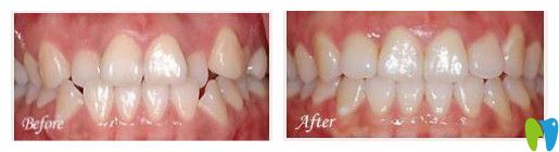 致美口腔時(shí)代天使矯正