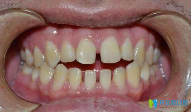 搖椅弓裝反了怎么辦