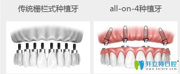 曲獻(xiàn)民科普：All-on-four全口種植優(yōu)勢(shì)體
