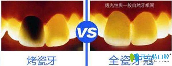 烤瓷牙與全瓷牙的區(qū)別